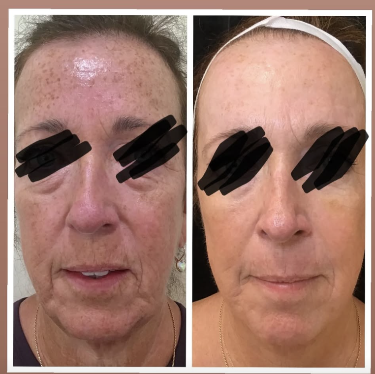 Before treatment - Client 4